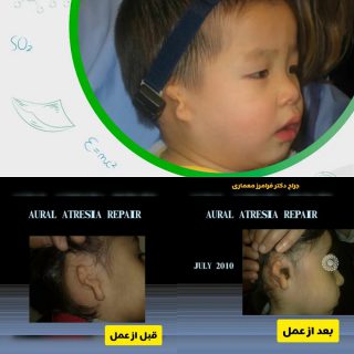 هرآنچه كه در باره آترزي گوش بايد بدانيم