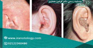 تومور گوش