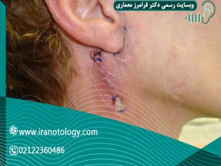 تومور پاروتید