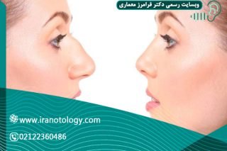 پوست چرب بینی بعد از جراحی