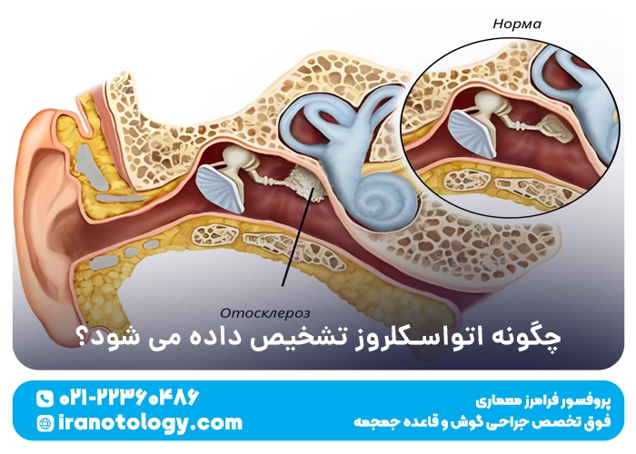 چگونه اتواسکلروز تشخیص داده می شود؟