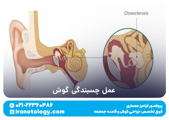 عمل چسبندگی گوش
