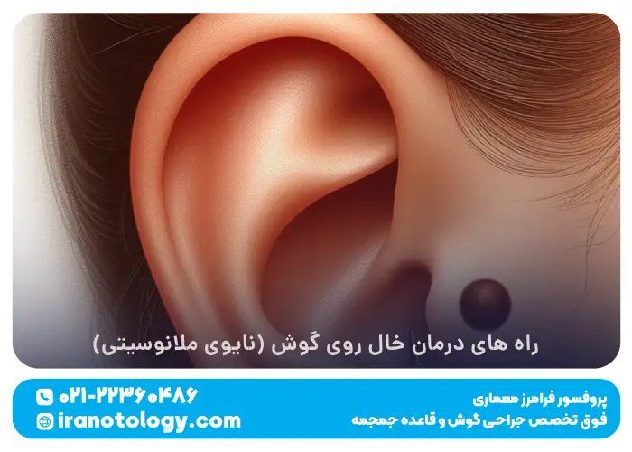 راه های درمان خال روی گوش (نایوی ملانوسیتی)