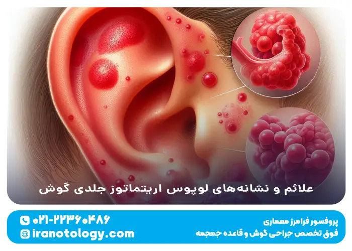 علائم و نشانه_های لوپوس اریتماتوز جلدی گوش