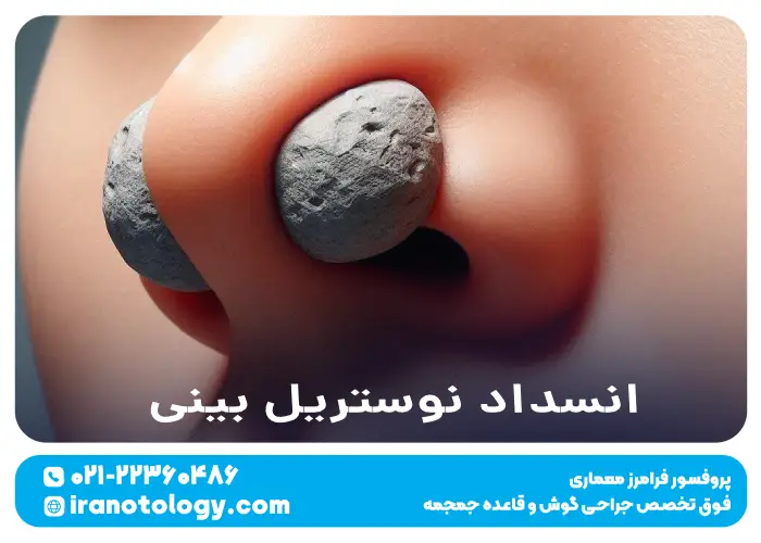 انسداد نوستریل بینی