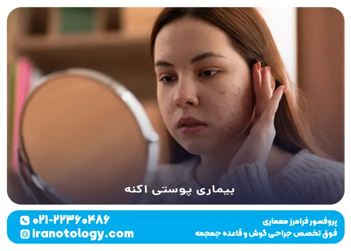 اکنه