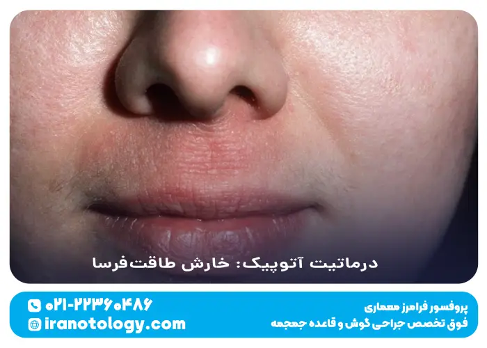 درماتیت آتوپیک_ خارش طاقت_فرسای پوست بینی