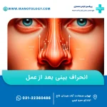 آیا انحراف بینی بعد از عمل برمیگردد؟