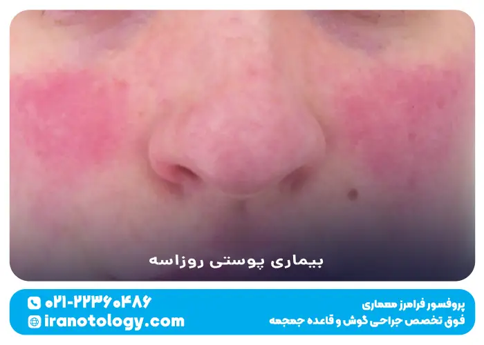 بیماری پوستی روزاسه