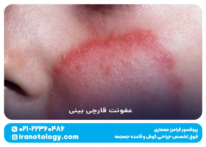 عفونت قارچی بینی