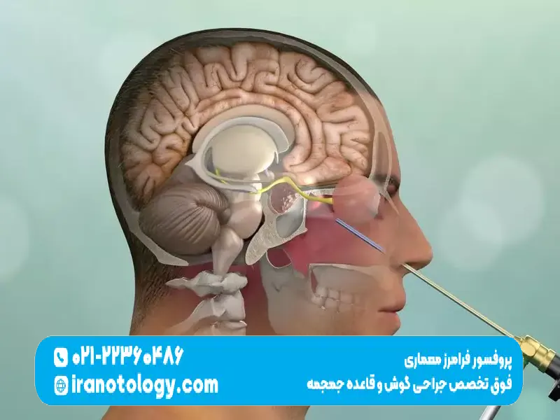 جراحی قاعده جمجمه