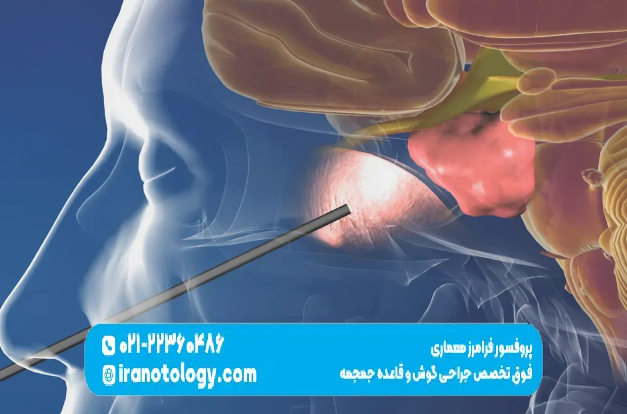 جراحی قاعده جمجمه