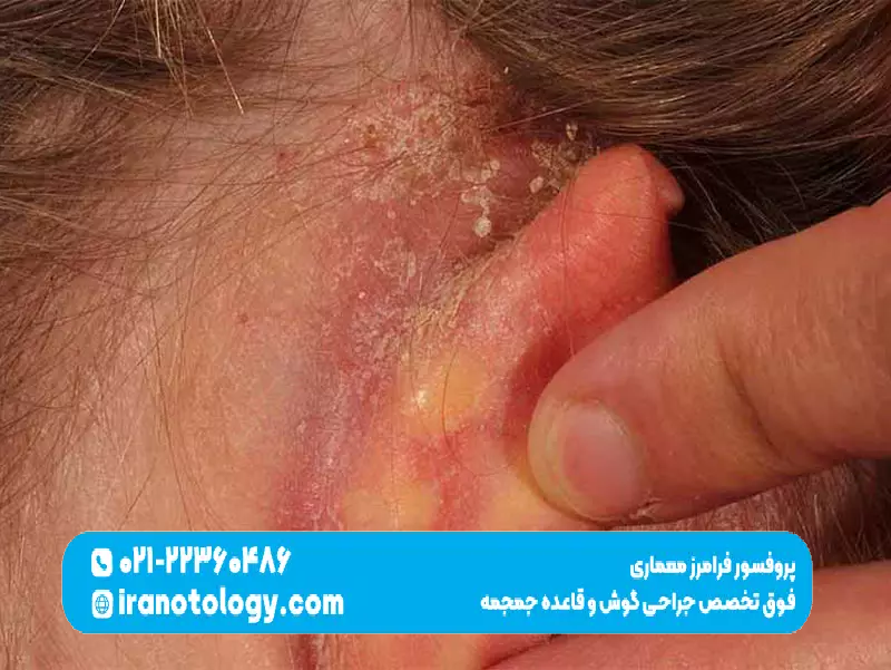 پسوریازیس