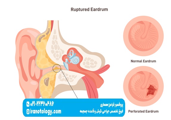 پارگی پرده گوش