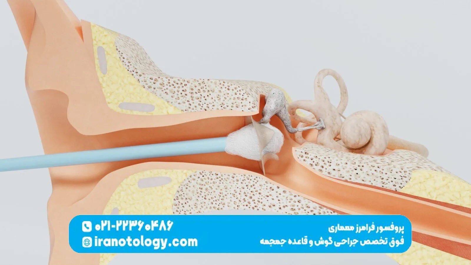 پارگی پرده گوش