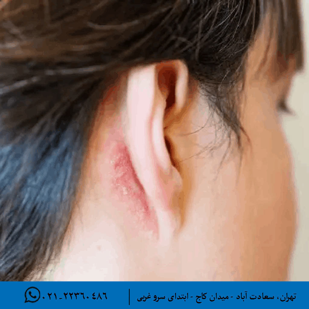 علائم هشداردهنده بعد از جراحی آترزی گوش