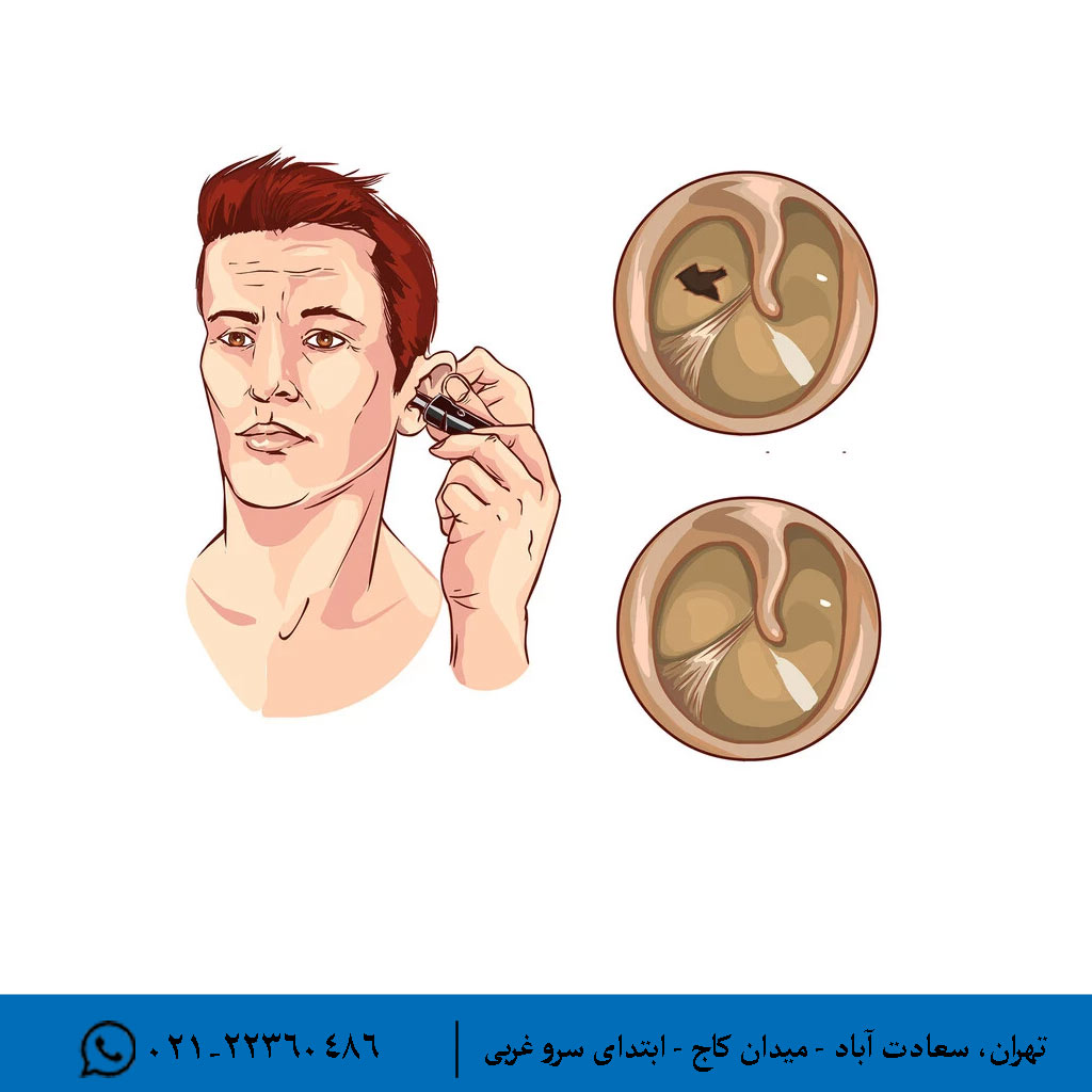 عوارض بلندمدت و جدی پارگی پرده گوش
