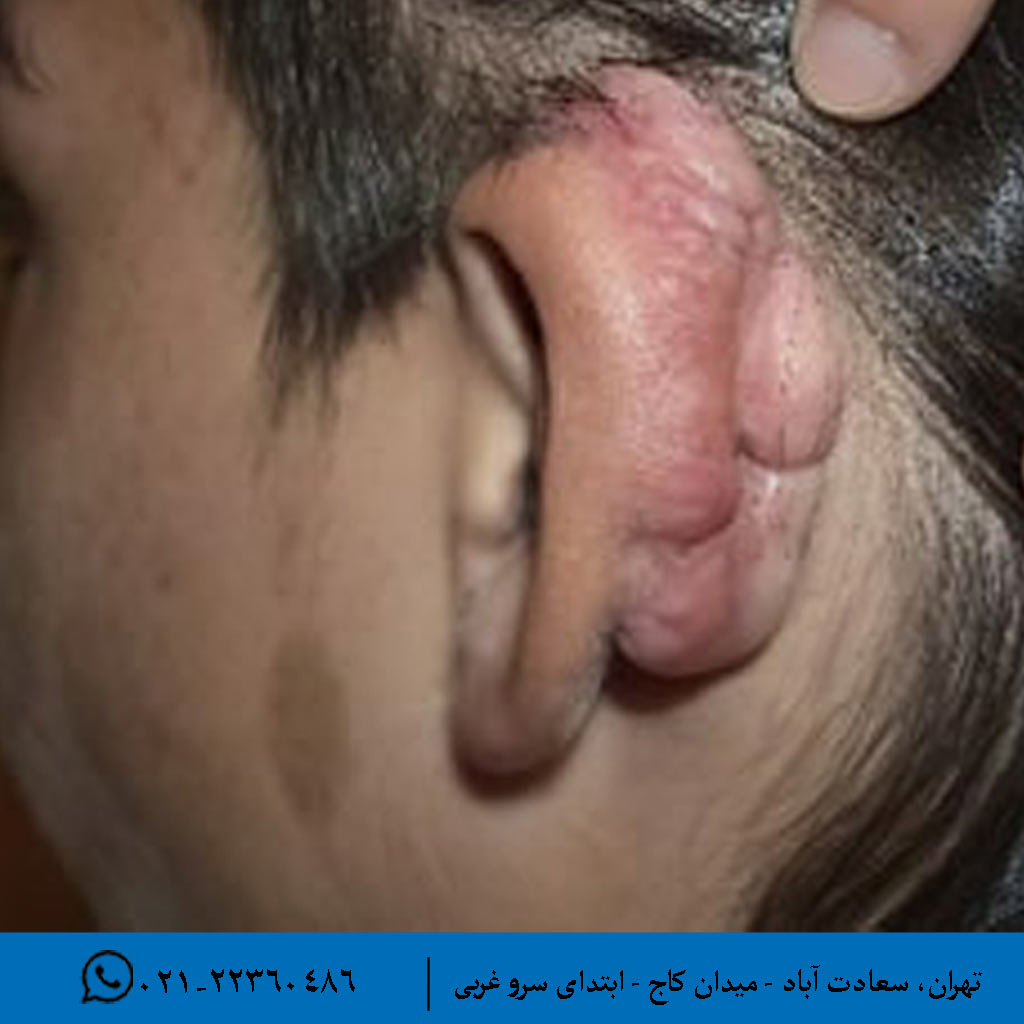 عوارض عفونی و التهابی بعد از عمل آترزی گوش