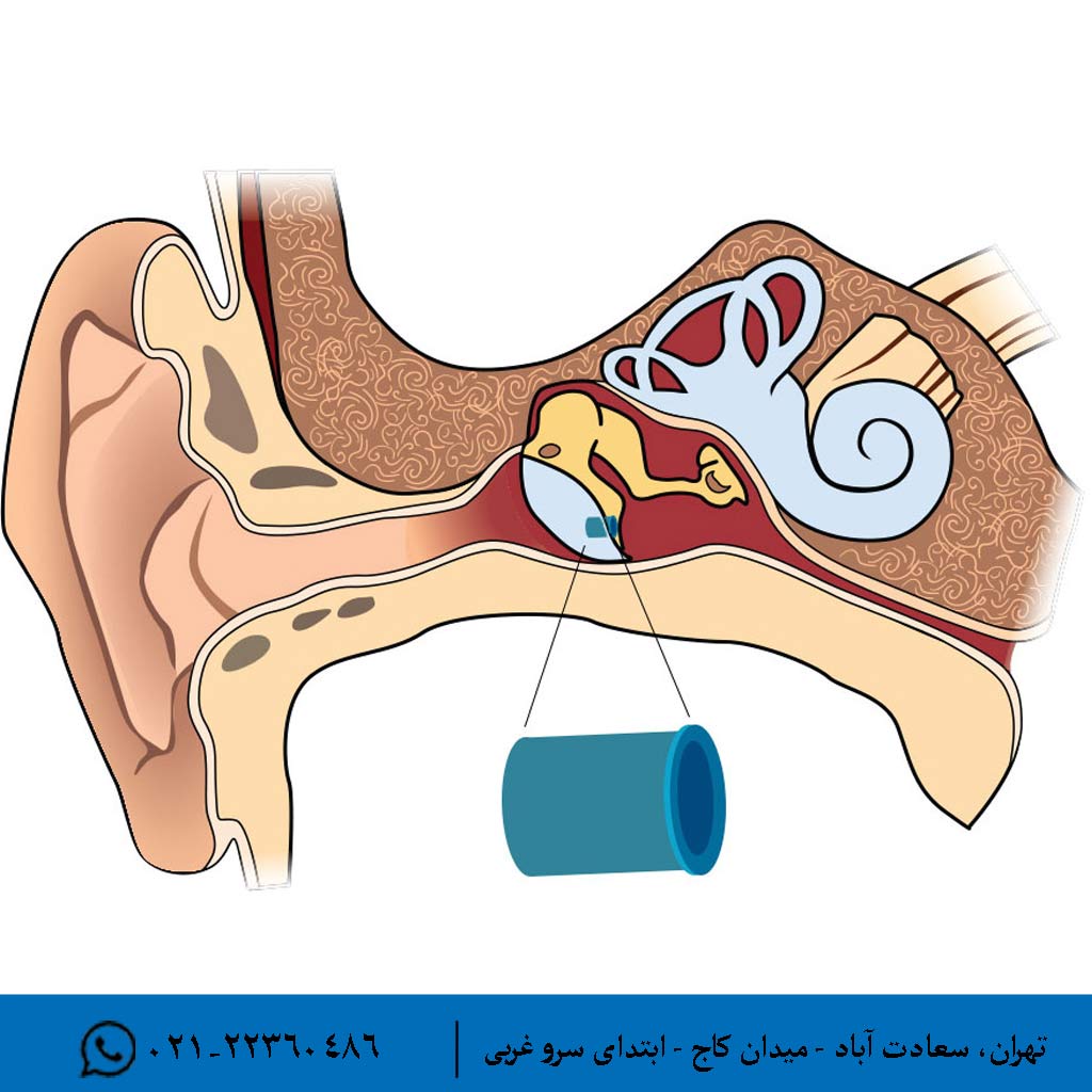 عوامل و شرایط همراه با پارگی پرده گوش