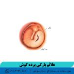 علائم پارگی پرده گوش